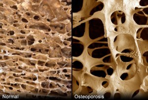 corte de hueso con y sin osteoporosis