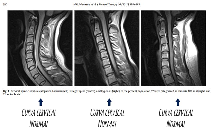 Tres imágenes correpondientes a tres RMN de una curvatura cervical normal y dos alteraciones de esta hacía la rectificación