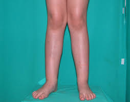 Imagen de los miembros inferiores de un niño en bipedestación con valgo de rodillas