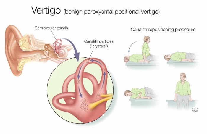 anatomía del vértigo paroxístico benigno