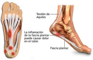 zonas de dolor de la fascia plantar