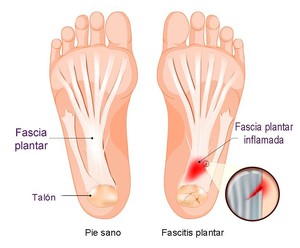 fascia plantar y su zona de dolor