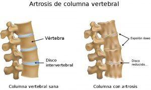 artrosis en la columna lumbar