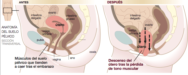 corte de la pelvis femenina con prolapso uterino