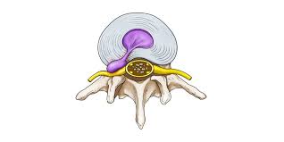 hernia discal