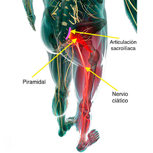 sindrome del piramidal