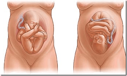 Imagen dela posición de un bebé dentro del vientre de la madre durate la gestación. En una posición vertical, con cabeza hacia arriba y otra con cabeza hacia abajo