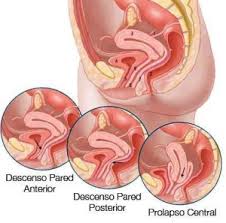 corte de abdomen y los tipos de prolapsos