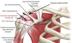 rotura del tendon del supraespinoso