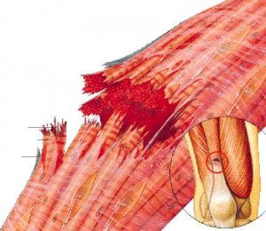 Imagen de una rotura muscular