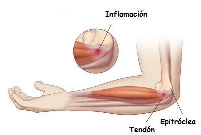 visión lateral del codo para ver la zona de inflamación 