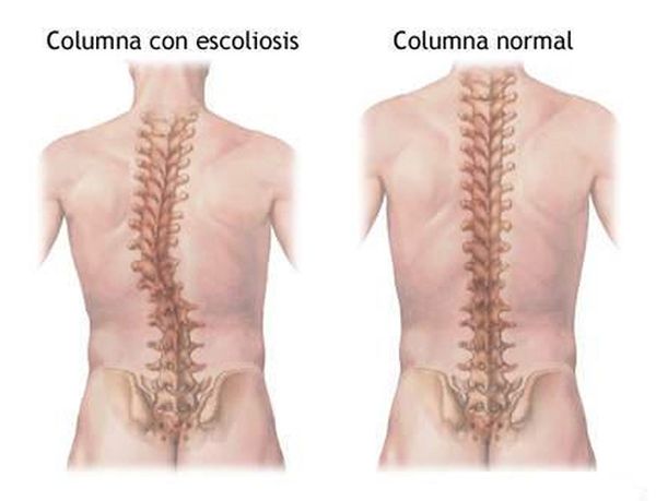 comparativa raquis con y sin escoliosis