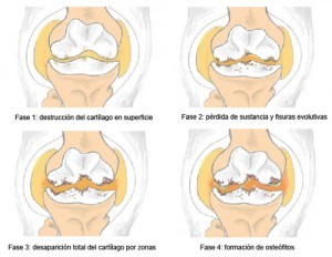 evolución de artrosis de rodilla 