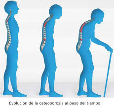 evolución de la postura hacia delante con el paso de la artrosis