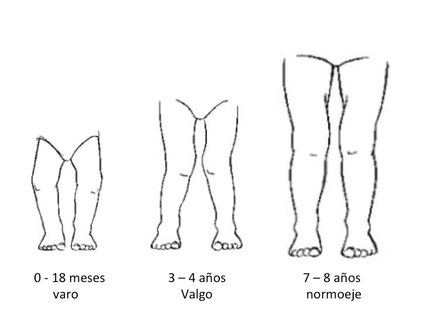 Dibujos donde se muestra la evolución fisiologica en la posición de varo y valgo de rodillas en la evolución de los niños
