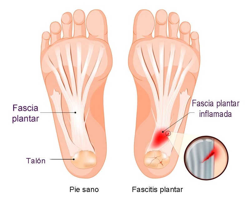 fascia plantar
