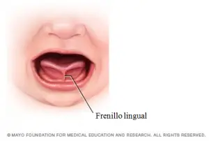 frenillo lingual