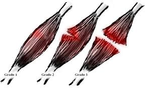 tres imágenes esquemáticas de roturas musculares de grado 1, 2 y 3