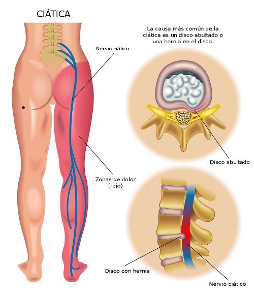 esquema de la ciática desde la columna hasta el pie