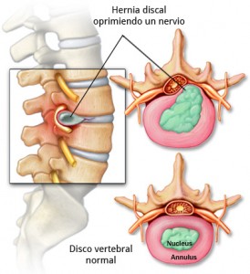 anatomia de la columna vertebral con una hernia discal