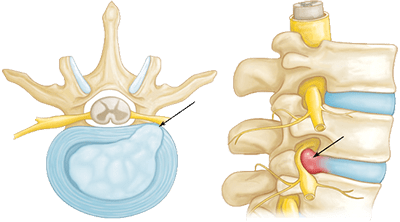 Imagen en visión lateral y sagital de una hernia discal derecha a nivel lumbar