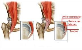 articulación de la cadera y su labrum