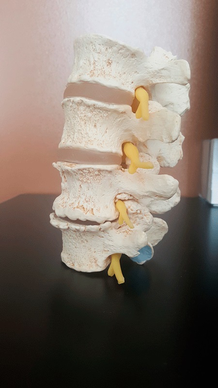Modelo anatómico con el que trabajamos en Innofisio de una columna lumbar con degeneración progresiva en casa vértebra