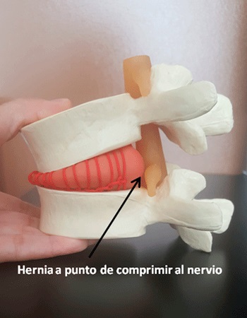 modelo anatómico de una hernia lumbar. Modelo con el que trabajamos en Innofisio