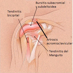 imagen del hombro con la bolsa sinovial inflamada