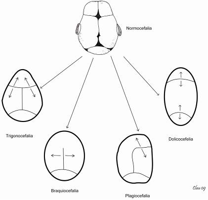 Plageocefalia tipos de cráneo