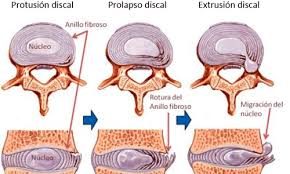 Progresión en la formación de una hernia discal lumbar