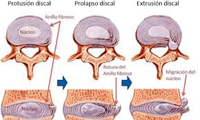 Hernia o protusión discal diferencias - Ana Quiropractica