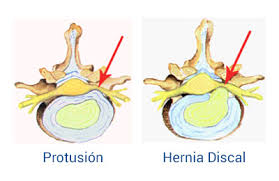 ¿Qué es una protusión discal?