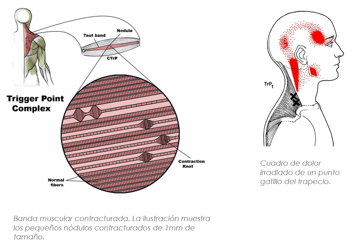 Imagen microscópica de una contractura y mapa de dolores referidos de los puntos gatillo del trapecio superior