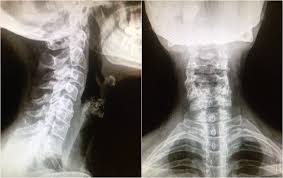 radiografía artrosis