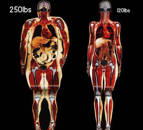 imagen de escaner de persona con y sin sobrepeso