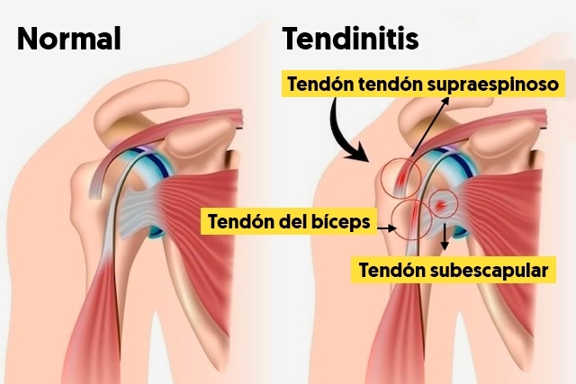 anatomia del hombro y sus tendones