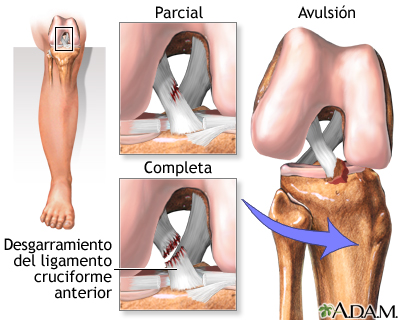 tipos de rotura del ligamento cruzado de rodilla